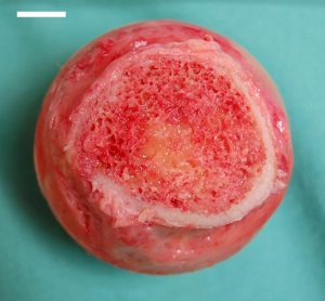 Caput femoris cortex medulla; "section through the head of the femur, showing the cortex, the red bone marrow and a spot of yellow bone marrow"