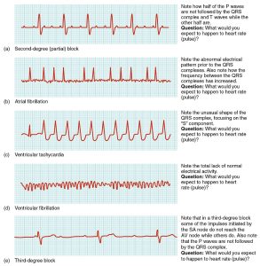 This image depicts five cardiac arrhythmias on a graph. 1. Second-degree (partial) block: Note how half of the P waves are not followed by the QRS complex and T waves while the other half are. What would you expect to happen to heart rate (pulse)? 2. Atrial fibrilation: Note the abnoraml electrical pattern prior to the QRS complexes. Also note how the frequency between the QRS complexes has increased. What would you expect to happen to heart rate (pulse)? 3. Ventricular tachycardia: Note the unusual shape of the QRS complex, focusing on the "S" component. What would you expect to happen to heart rate (pulse)? 4. Ventricular fibrilation: Note the total lack of normal electrical activity. What would you expect to happen to heart rate (pulse)? 5. Third degree block: Note that in a third degree block some of the impulses initiated by the SA node do not reach the AV node while others do. Also note that the P waves are not followed by the QRS complex. What would you expect to happen to heart rate (pulse)?