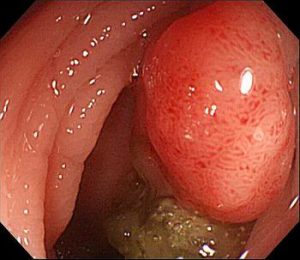 https://commons.wikimedia.org/wiki/File:Colon-Polyp.jpg