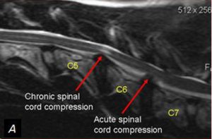 compression of the spine