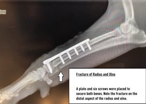 Fracture distal radius and ulna, plate and six pins placed,image credit KRobertson