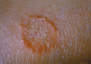 Ringworm on the skin of a human