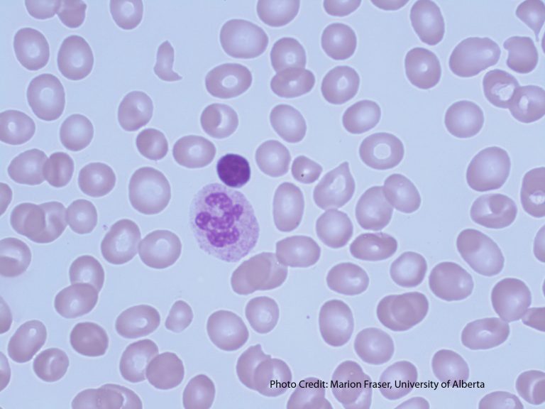 Neutrophil Hypersegmentation – A Laboratory Guide to Clinical Hematology