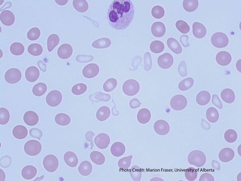 Sideroblastic Anemia – A Laboratory Guide to Clinical Hematology