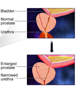 Benign prostatic hyperplasia with an enlarged prostate compared to normal sized prostate