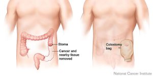 example of colostomy bag/colostomy due to cancer