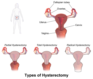 Different types of hysterectomy. Partial, total and radical types