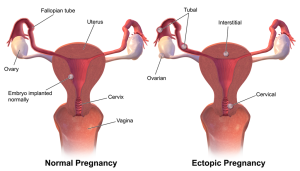 normal pregnancy location in the uterus compared to ectopic pregnancy in the ovary, abdomen or fallopian tubes