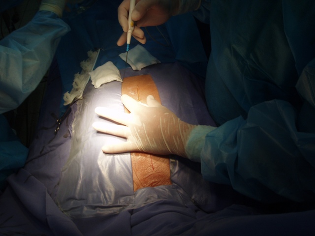 Surgeons putting an incision into the patients abdomen
