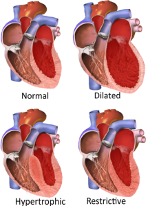 normal, dilated, hypertrophic and restrictive types of cardiomyopathy